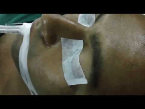 Cosmetic Surgery Nose : Septoplasty and Rhinoplasty