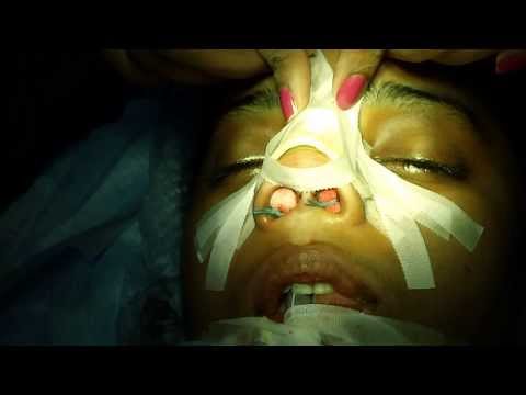 Cosmetic Surgery of Nose In Trivandrum Kerala India (Crooked Nose)