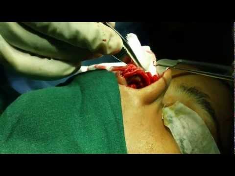 Cosmetic Surgery of Nose (Rhinoplasty) in Hemifacial Atrophy