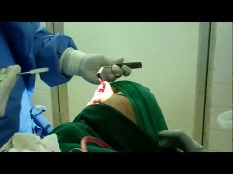 Cosmetic Surgery of Nose (Septorhinoplasty):Trivandrum, India
