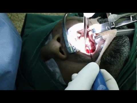 CPAP Altrenative Surgery