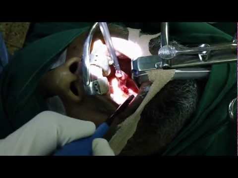 CPAP not working, What About Surgery?