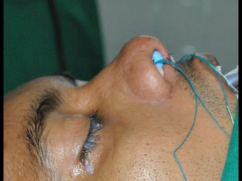 Crooked and Saddle Nose- Rhinoplasty