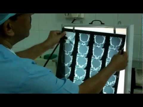 Deafness:Ear Surgery in India