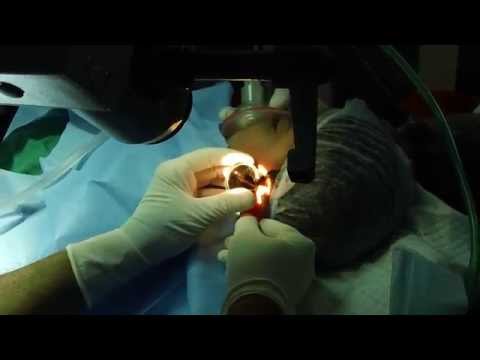 Dealing With Impacted Ear Wax in a 2 year Old