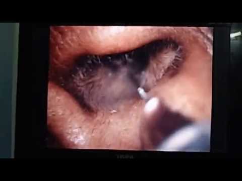 Diabetic Ear: Necrotizing Otitis Externa