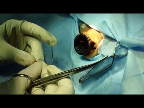 Dr Paulose: Bilateral Simultaneous One Sitting Ear Drum Repair