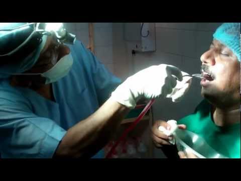 Draining Peri Tonsillar Abscess
