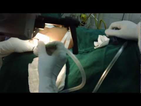 Ear Dewaxing by Suction