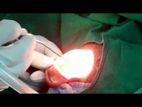 Ear Infection in health tourist in India