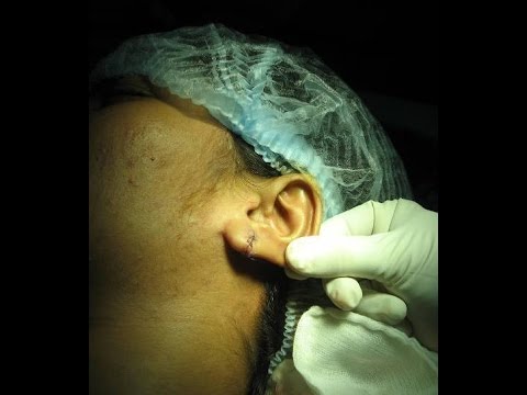 Ear Lobe Repair-Lobuloplasty