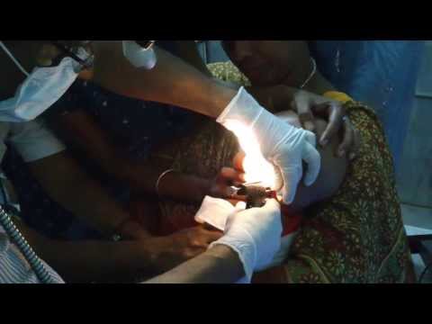 Ear piercing in a freightened child