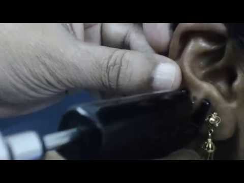 Ear Piercing Second Stud – Right