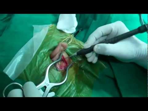Ear Surgery (Tympanoplasty) in India