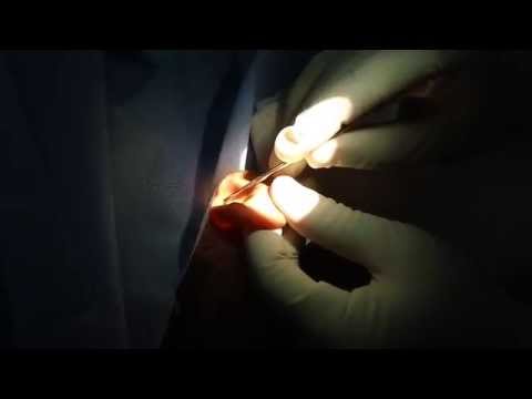 Ear Wax in Children-How to Remove it?