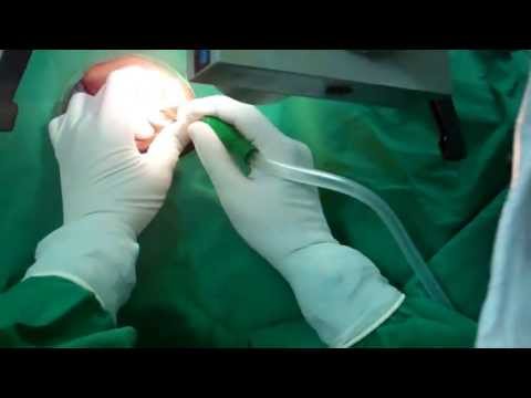 Ear Wax Removal