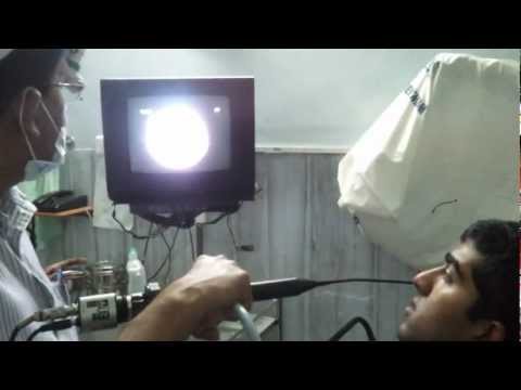 Endoscopic Examination:Snoring And OSA.mp4