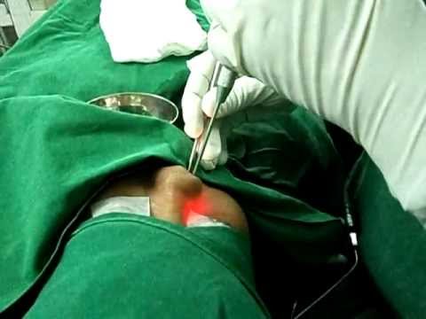 Endoscopic Nasal Sinus Surgery.
