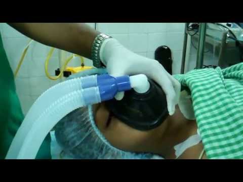 Endotracheal Intubation Procedure in Children-ENT Surgery