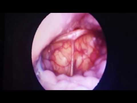 Epiglottis in Sleep Apnea: Floppy Closing Door Epiglottis