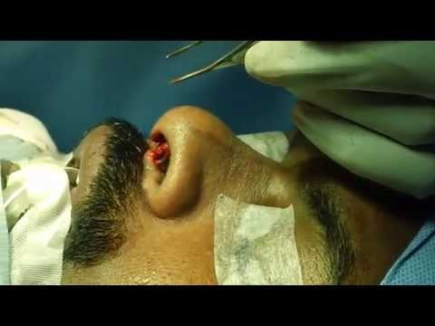Ethnic Indian Rhinoplasty Procedure