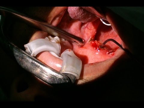 Excessive Daytime Sleepiness-Snoring Patients-Treatment