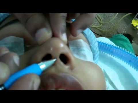External Rhinoplasty in Jubilee Hospital Trivandrum India