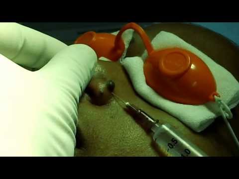 Facial Mole Removal by Laser in Trivandrum Kerala India