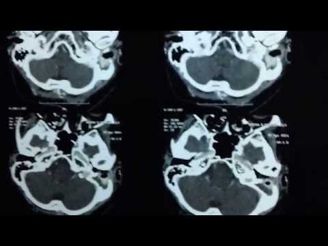 Facial Nerve Weakness_CT Scan Mastoid Bone