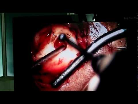 Failed Ear Surgery:Redo Mastoid and Tympanoplasty