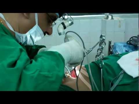 Familial Snoring and Treatment