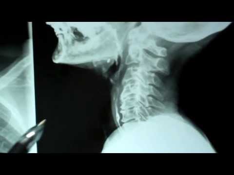 Feeling Something Stuck in the Throat
