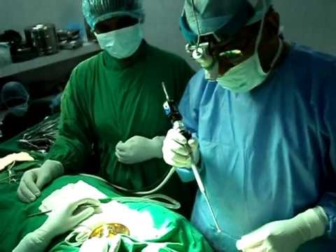 FESS and Caldwel Luc-Allergic Fungal Sinusitis