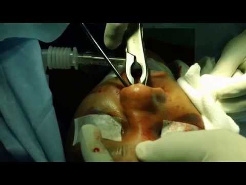 Fixing a Badly Broken Nose in an Women