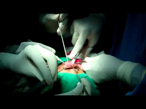 Functional Septo Rhinoplasty:How its done?