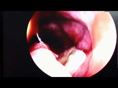 Fungal Sinusitis in India (Redo FESS)