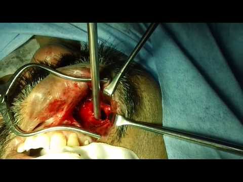 Fungal Sinusitis-Surgical Treatment