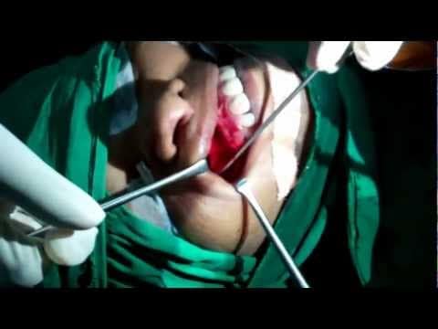 Fungal Sinusitis: Treatment