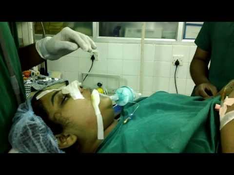 GA Extubation after Rhinoplasty