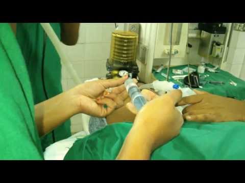 GA intubation for Sleep Surgery in Trivandrum Kerala India