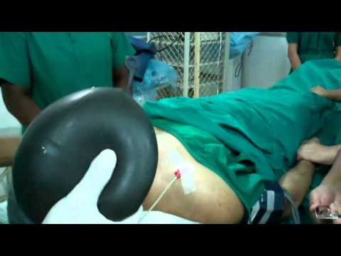 General Anesthesia For Laser Tonsillectomy