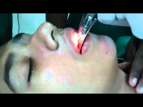 General Anesthesia in ENT: Intubating Anu Rose