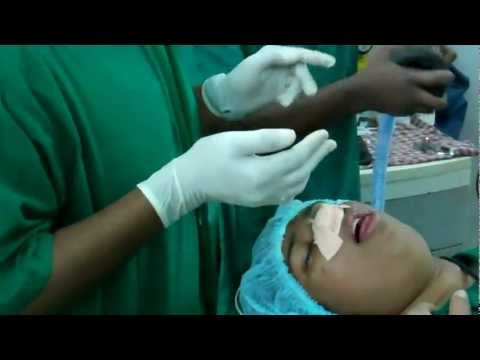 General Anesthesia in ENT Surgery :Waking up the Patient