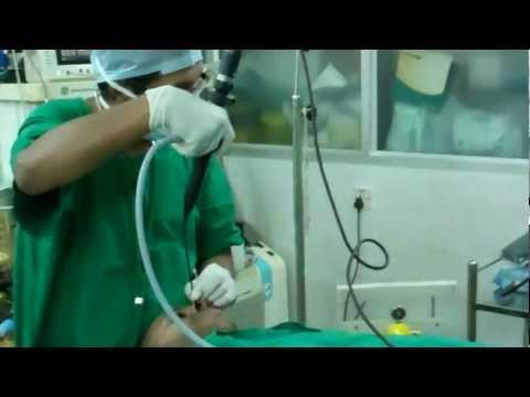 General Anesthesia :Laryngoscopy First