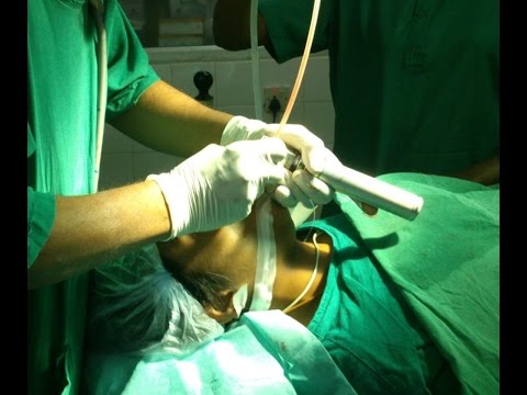 General Anethesia Extubation After Rhinoplasty