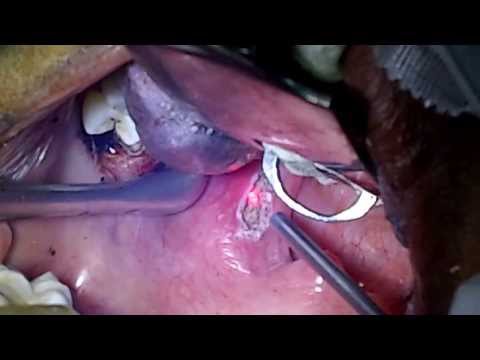 Get rid of Bad Breath (Halitosis) by Laser Therapy