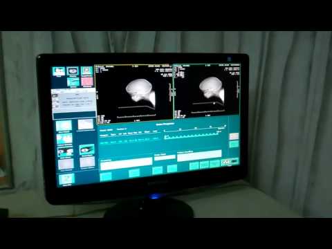 Getting a CT Scan of Adenoid done in Children