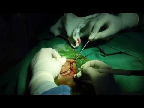 Getting Ear Surgery Done in Trivandrum, South India
