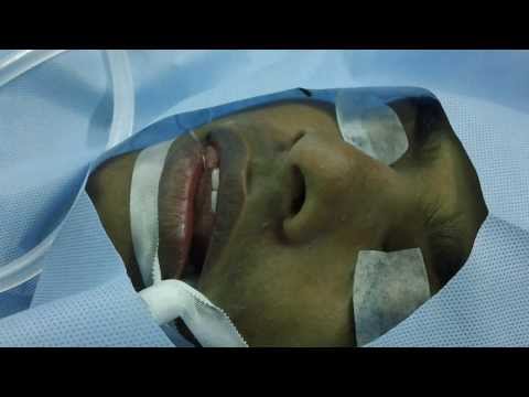 Getting Fracture Nose (Broken Nose) Fixed