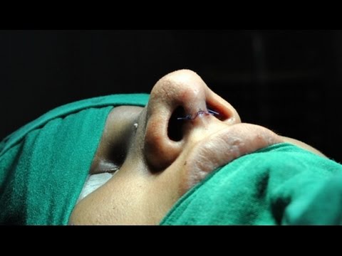 Getting Nose Reshaped in India (Nose Job Rhinoplasty)